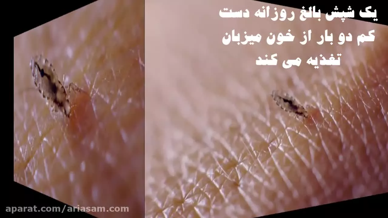 چرا شپش ها سبب خارش می شوند | شامپو ضد شپش و تخم شپش دی فنوترین