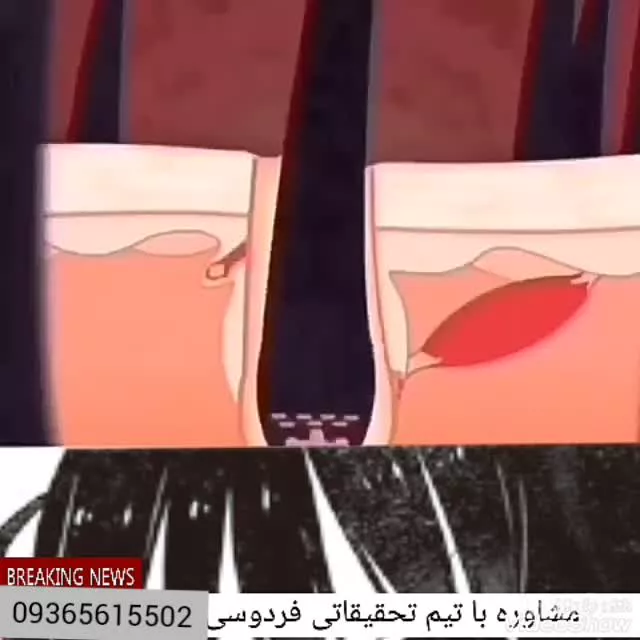ددمان سفیدی مو و ریزش مو در طب سنتی
