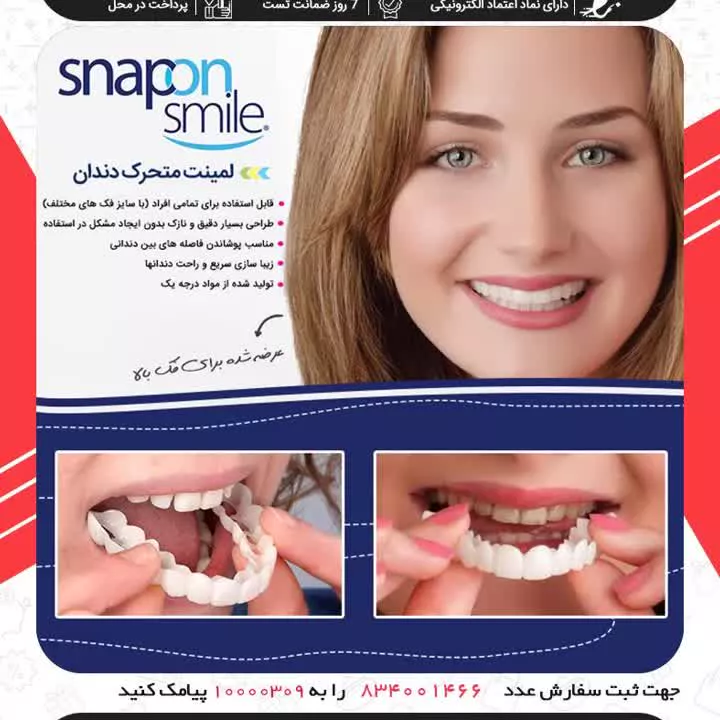 خرید لمینت متحرک دندان-09363660478