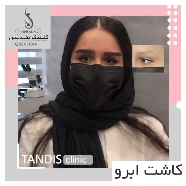 کاشت ابرو ۲۵
