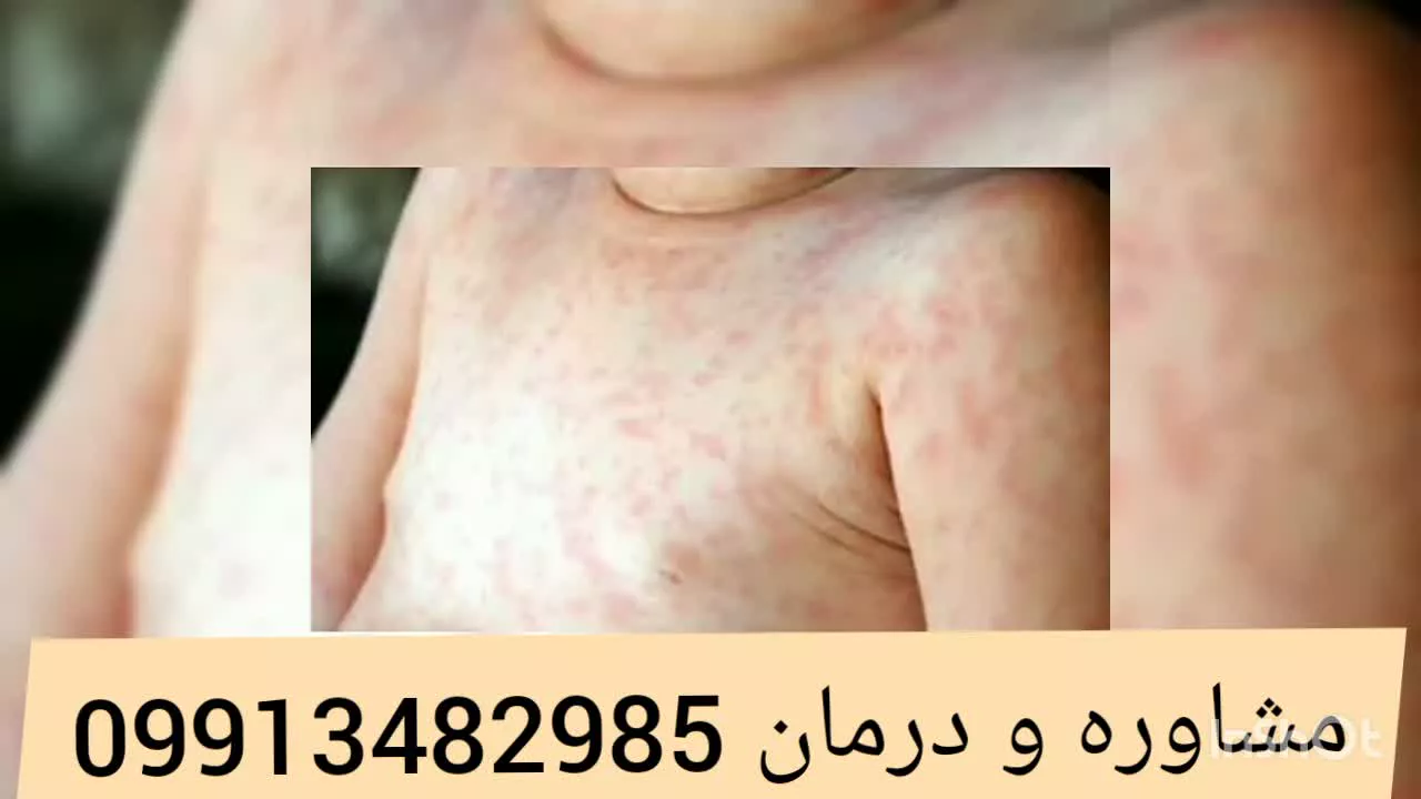 اولین درمان پسوریازیس