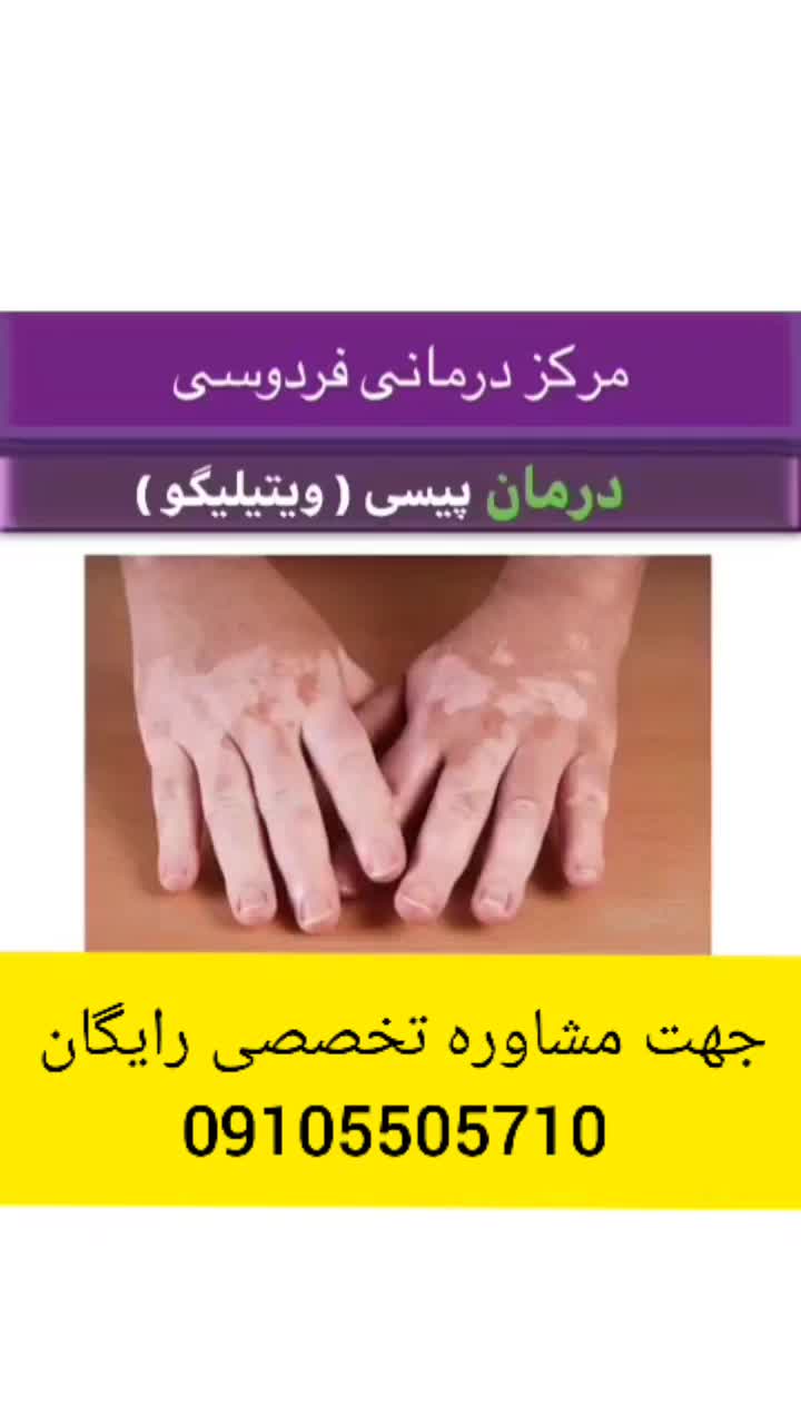 ویتیلیگو درمان شد/داروی آن در طب نوین