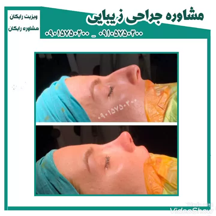فیلم عمل بینی در مشهد