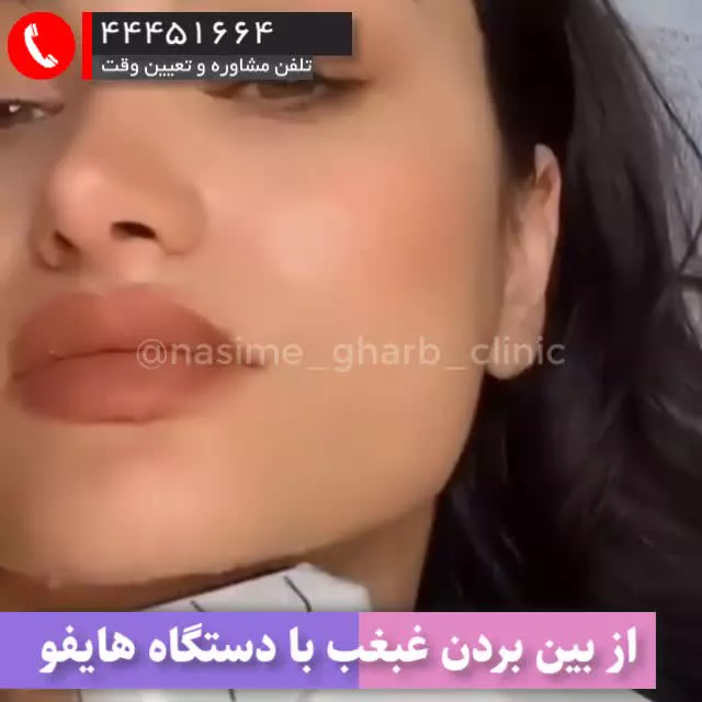 بین بردن غبغب با دستگاه هایفو