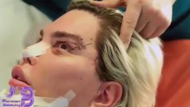 عمل جراحی دوست پسر باربی در ایران کلینیک زیبایی پارسیان بیوتی