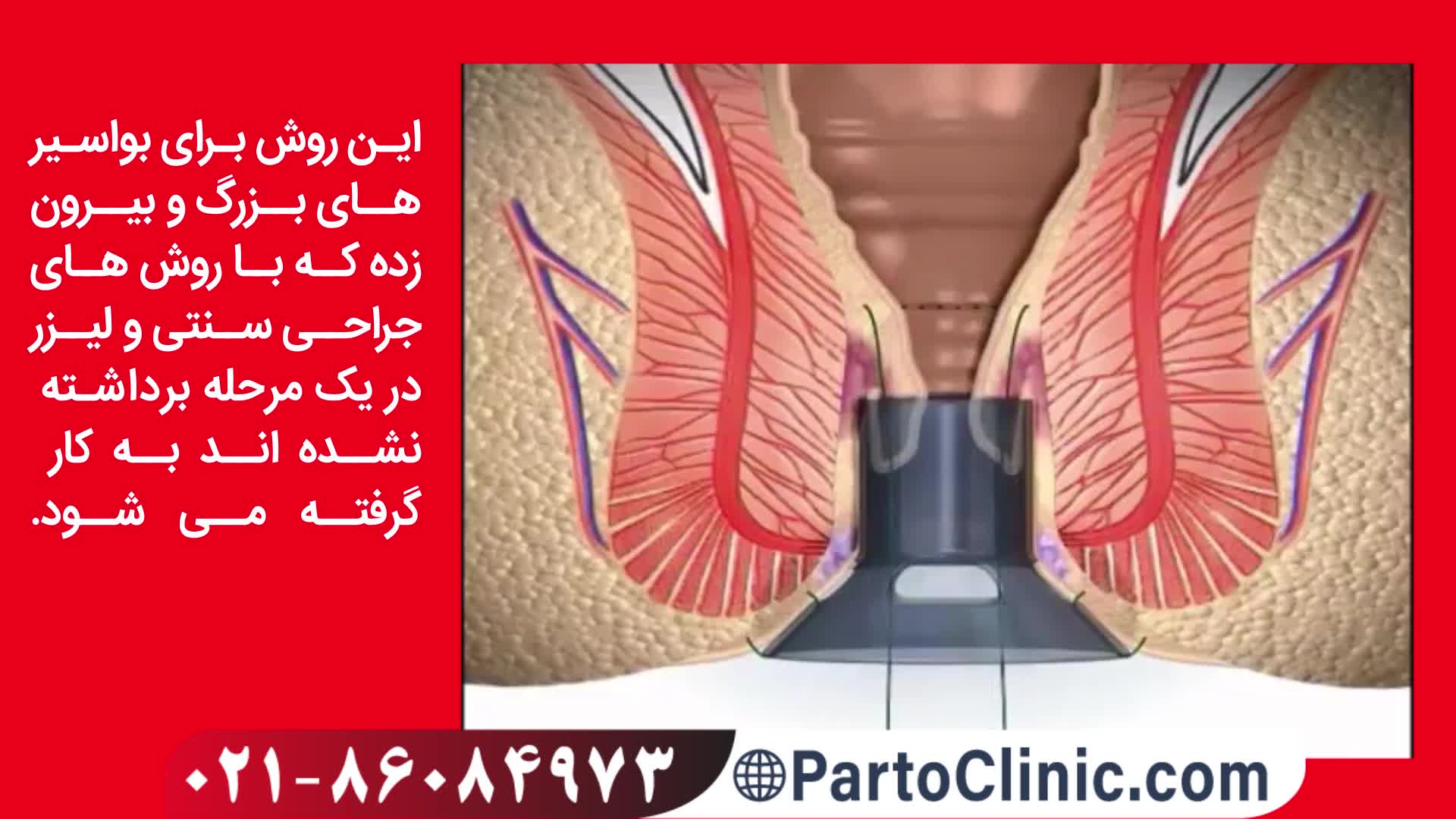 درمان هموروئید یا بواسیر با استاپلر partoclinic.com