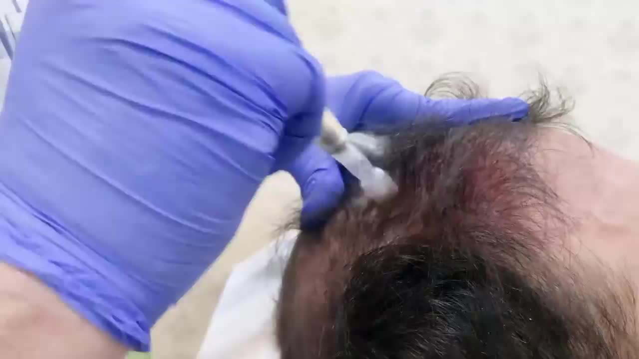 مزونیدلینگ پوست سر