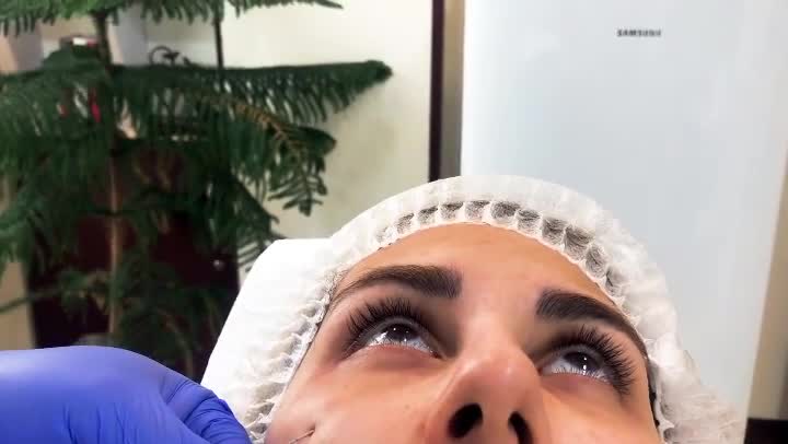 تزریق فیلر زیر چشم