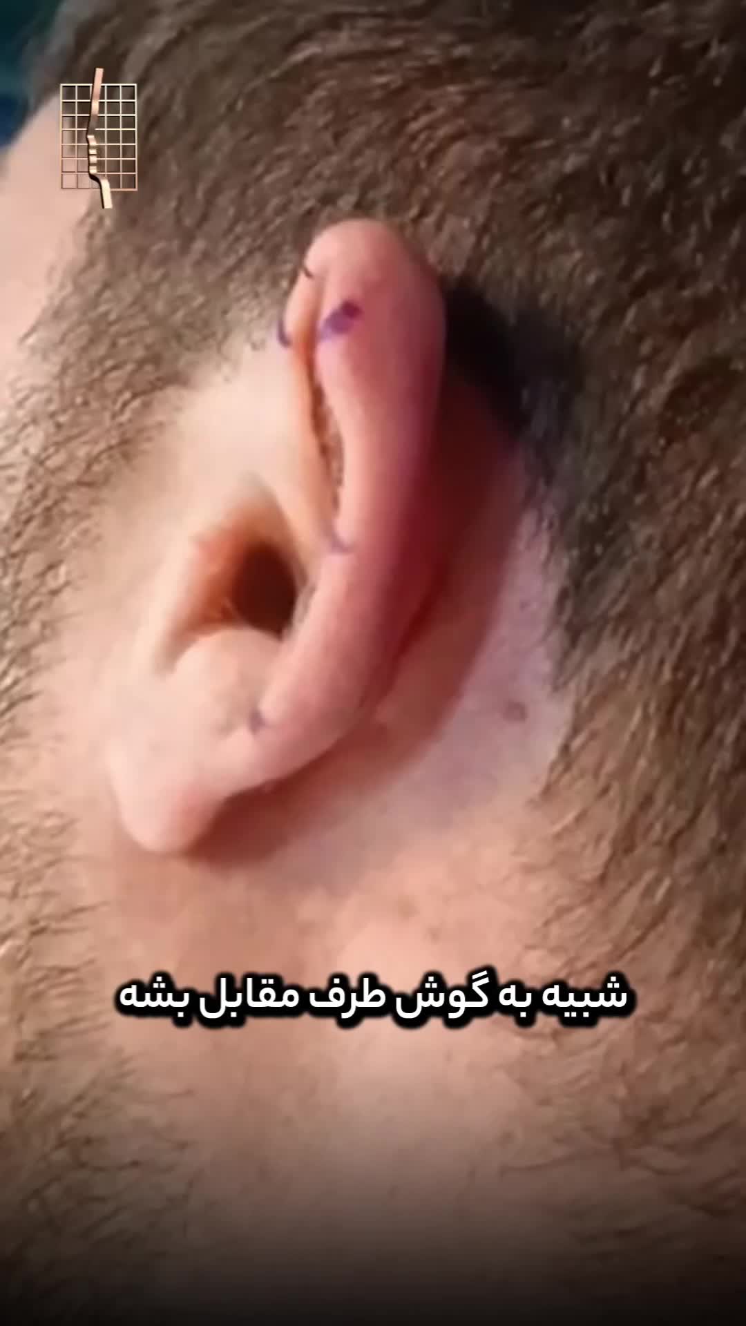 جراحی اتو پلاستی در اصلاح دفورمیتی LopEar