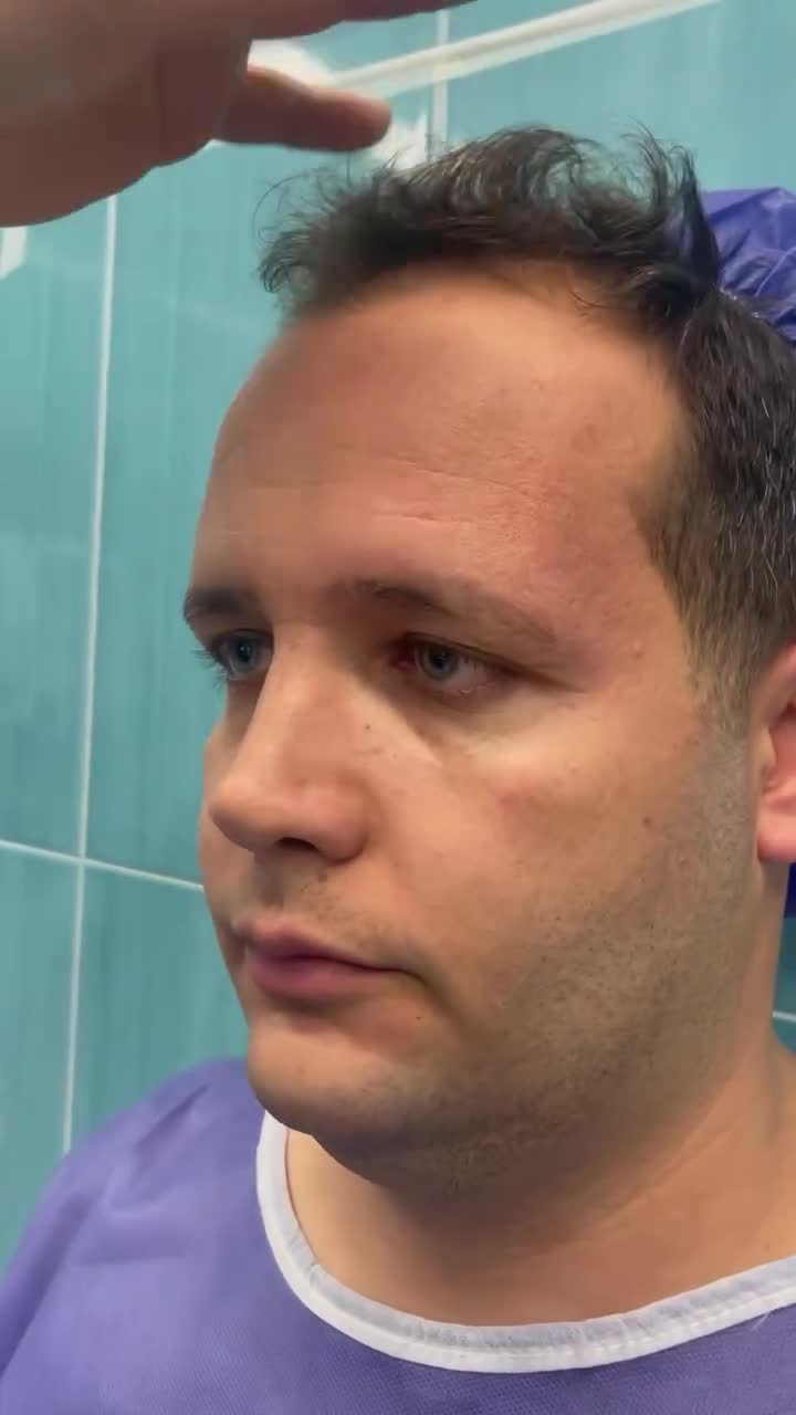 عمل جراحی لیفت ابرو پلک بالا و کوتاه کردن پیشانی