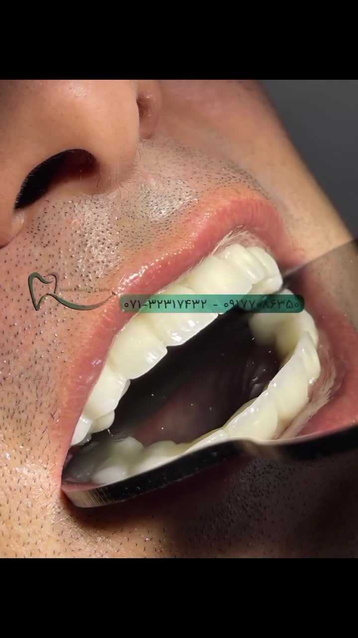 ایمپلنت دندان کلینیک دندانپزشکی امین شیراز