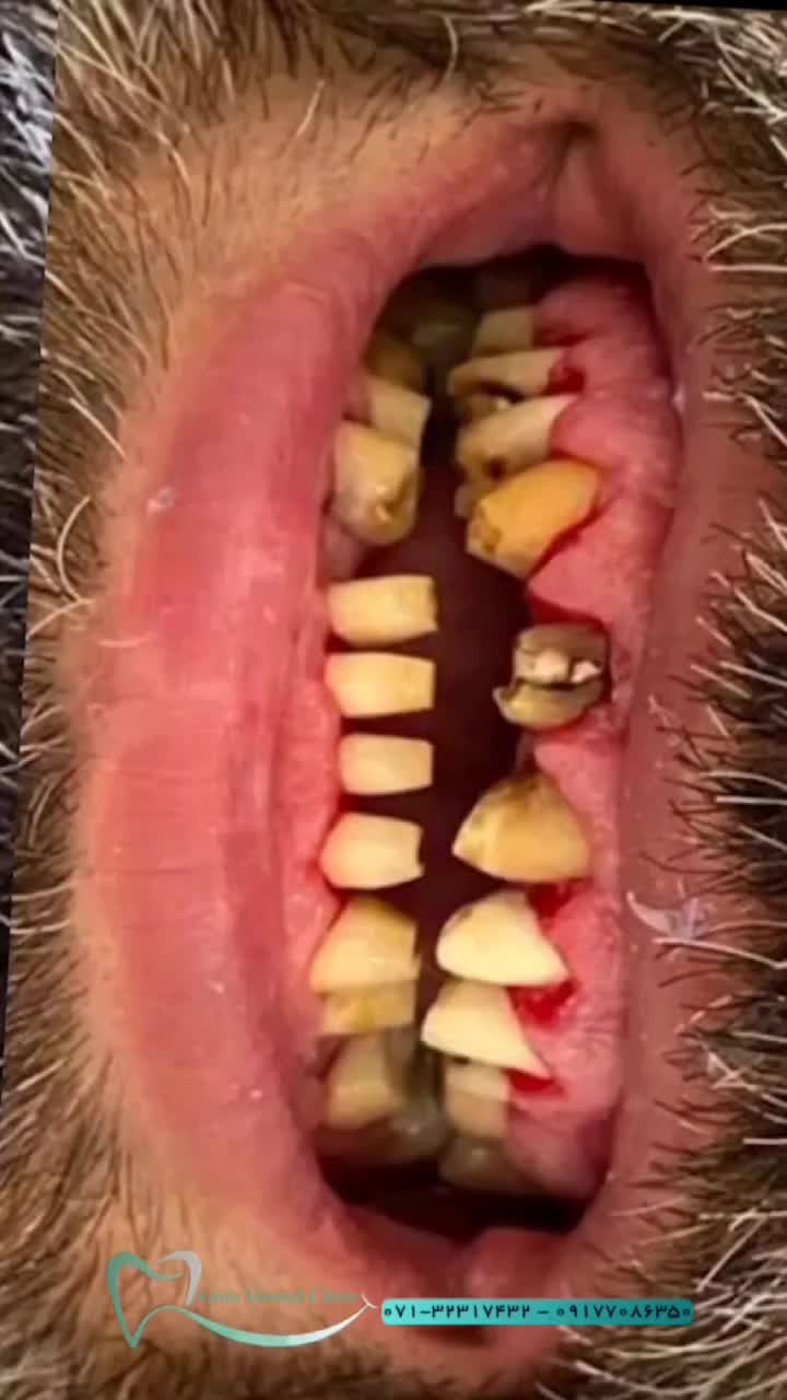 ایمپلنت یا کاشت دندان با دندانپزشکی امین شیراز