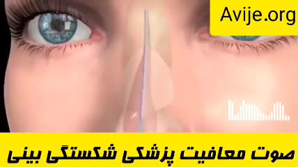 آیا انحراف بینی باعث معافیت سربازی می شود؟