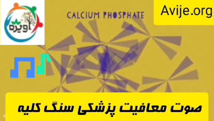 معافیت موقت سنگ کلیه