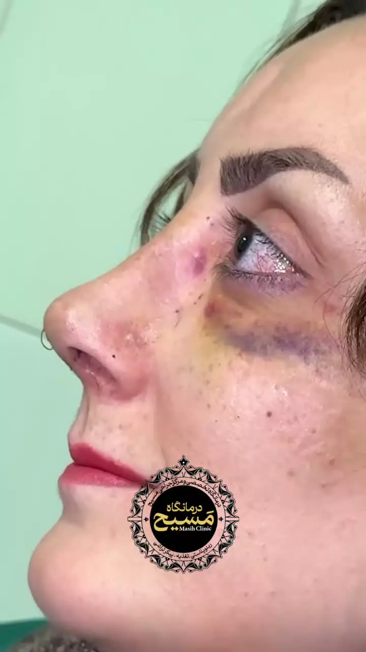 قبل و بعد عمل انحراف بینی در درمانگاه مسیح