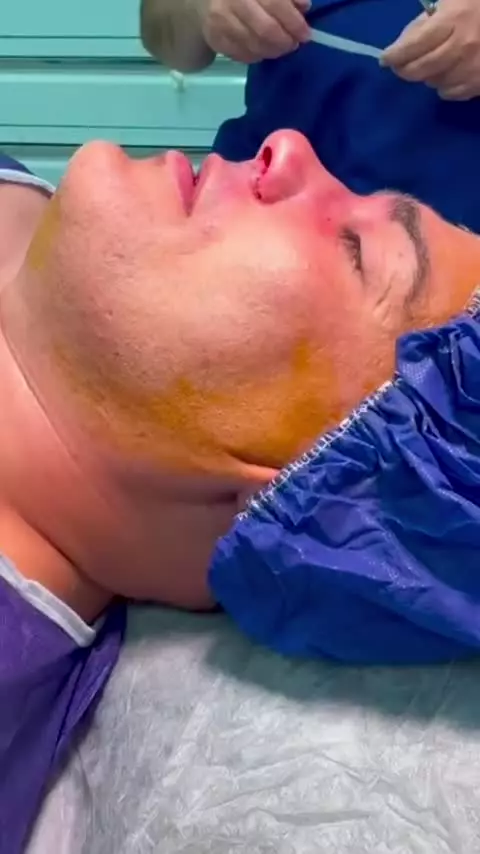 عمل بینی بدون بیهوشی مردانه در کلینیک مسیح