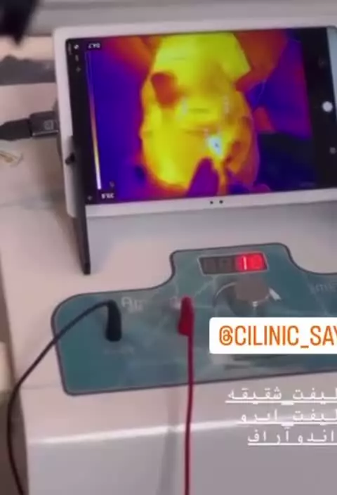 لیفتینگ و جوانسازی پوست با دستگاه پزشکی Aphrodite