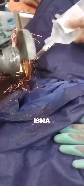 ببینید| نجات معجزه‌آسای کارگر ساختمانی پس از سقوط و فرو رفتن میلگرد در بدنش | 11 خرداد 1404