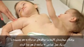 جدا سازی دوقلوهای دوساله جسبیده به هم در کالیفرنیا