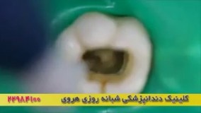 فیلم پر کردن دندان بعد از عصب کشی دندان