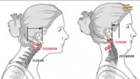 فیزیوتراپی بیماریهای گردن