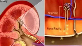 وحشتناک ترین درد دنیا را خودتان درمان کنید - دلایل ابتلا به سنگ کلیه و راه های پیشگیری