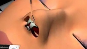 انیمیشن توضیح کامل جراحی زیبایی بینی
