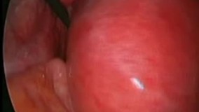 عمل جراحی فیبروم رحم