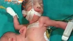 ????نوزاد عجیب الخلقه با یک سر اضافه روی شکمش ..