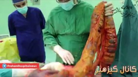 خارج کردن توده ی چند کیلویی از روده ی بزرگ بیمار!
