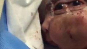 تولد کودکی با سری دورو ، سه تا چشم و دو بینی  ایران_قشم