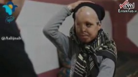 فیلم/ مصاحبه غم انگیز با تنها دختربچه‌ قربانی اسیدپاشی در ایران