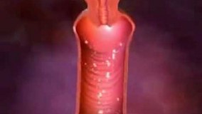 درمان خانگی عفونت واژن- قسمت -19-دارو برای عفونت قارچی واژن 