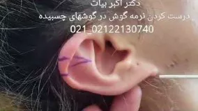 اصلاح سایز لاله و نرمه گوش