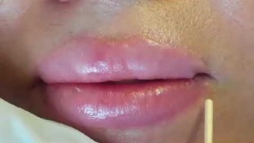 جراحی لب و درم ابریژن بعد از جراحی به جهت محو کردن کامل جای زخم