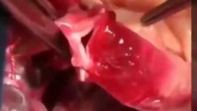 جراحی پیوند قلب