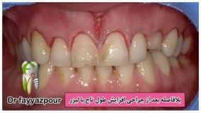 کلیپ جراحی لثه - 4