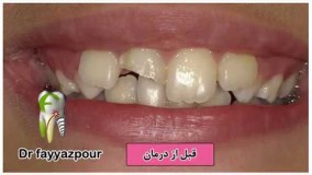 ترمیم زیبایی دندان شکسته با کامپوزیت