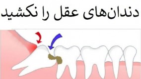 بیدلیل دندانهای عقل را نکشید