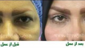 نمونه جراحی های افتادگی پلک، بلفاروپلاستی دکتر محمدطاهر رجبی