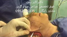 لیفت صورت و گردن توسط فوق تخصص جراحی سر و گردن؛ بهترین جراح پلاستیک تهران