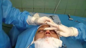 آخرین مرحله جراحی بینی فروزان