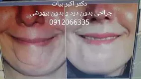 جراحی اسکار صورت توسط  یکی از با سابقه دارترین جراح پلاستیک تهران