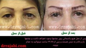 جراحی زیبایی پلک یا بلفاروپلاستی