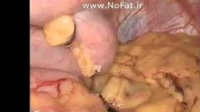 فیلم واقعی عمل اسلیو معده توسط دکتر هاشم زاده