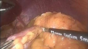 با عمل جراحي اسليو گاستركتومي لاغر ميشويد