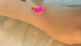 لیزر موهای زائد الکساندرایت