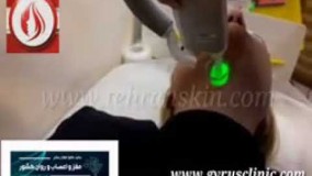 لیزر مو با دکتر لطفی در زیبان