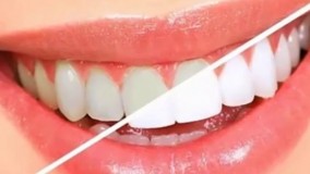 دانستنی های عجیب-6 راه سفید کردن دندان ها در خانه