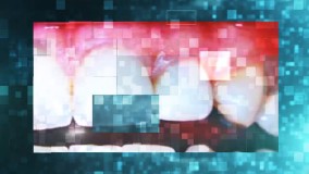 پوسیدگی دندان در دوران بارداری